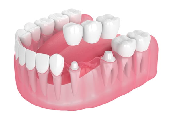 dental-bridges-7dental-findlay-creek