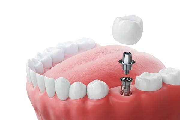 dental-implants-7dental-findlay-creek