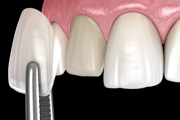 dental-veneers-7dental-findlay-creek