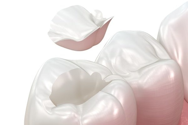 inlays-and-onlays-7dental-findlay-creek